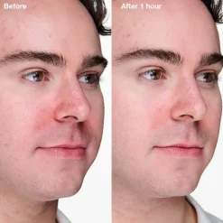 Anti-Blemish Solutions Clinical