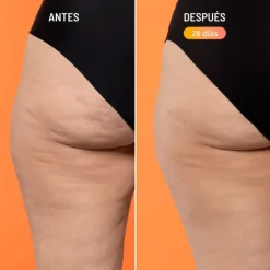 Beta-Burner Sculpting Treatment