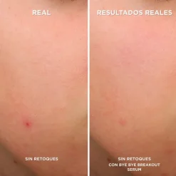 Bye Bye Breakout Sérum