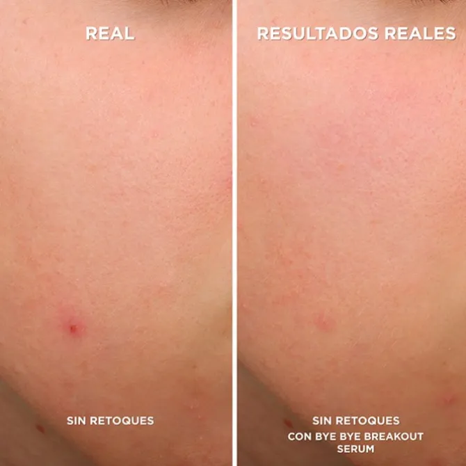 Bye Bye Breakout Sérum