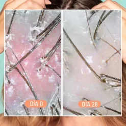 Dandruff & Scalp Exfoliating Treatment